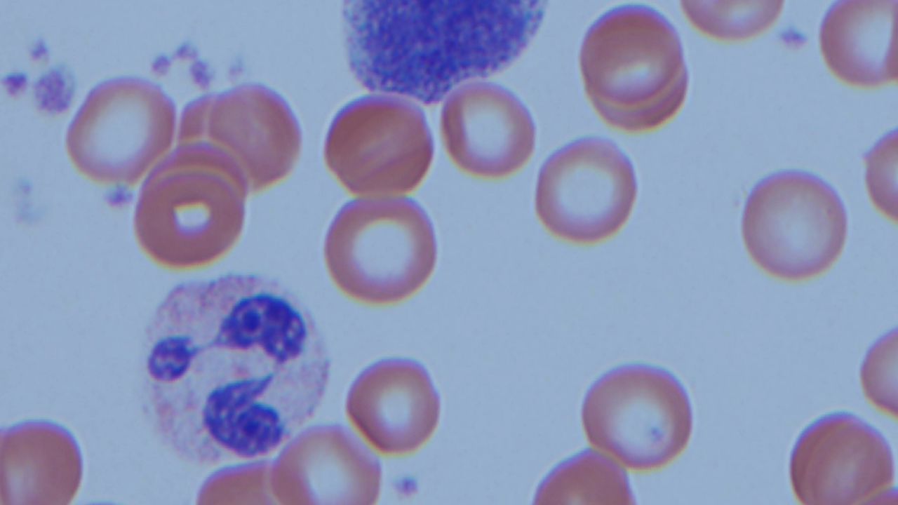 Blood smear from a COVID-19 patient.